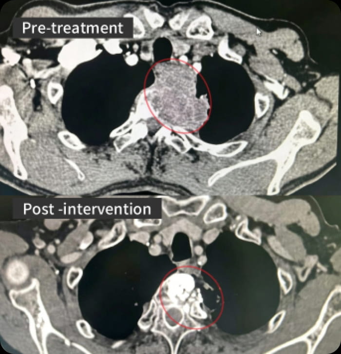 Image comparison before and after interventional treatment for patients with mediastinal lung squamous cell carcinoma