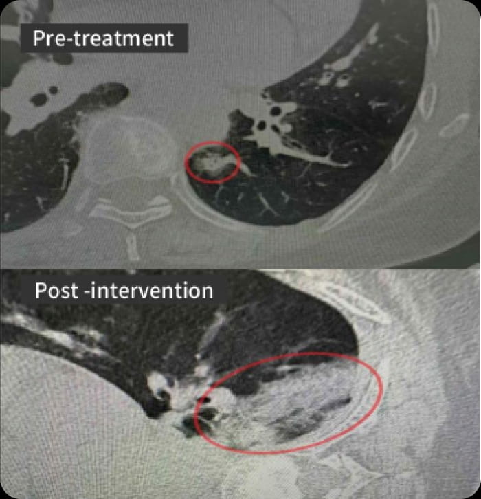Image comparison before and after cryoablation treatment in elderly lung cancer patients