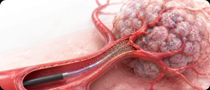 Vascular interventional technology accurately treats tumors