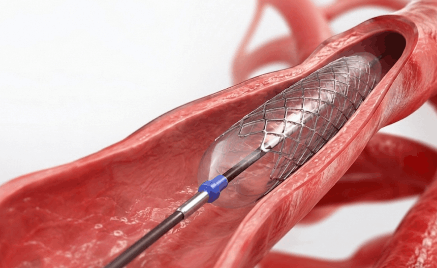 Stent Placement