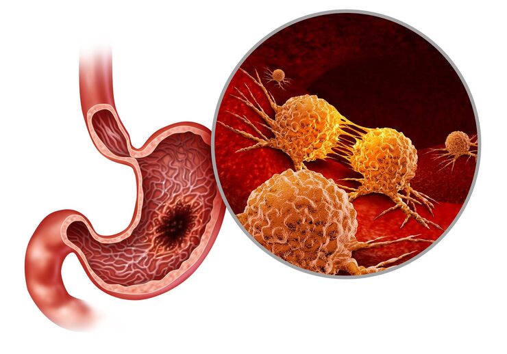 gastric