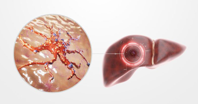 liver cancer image