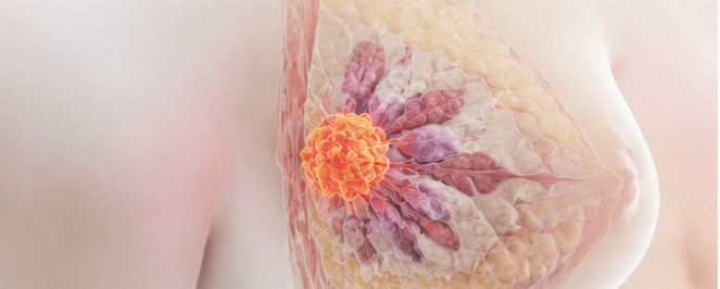 breast cancer image