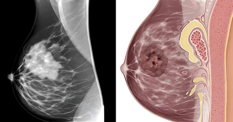 breast cancer image