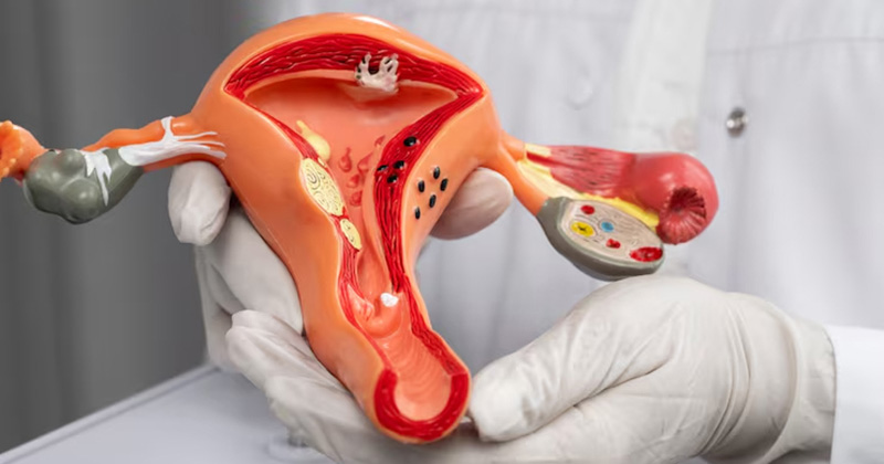 cervical cancer image