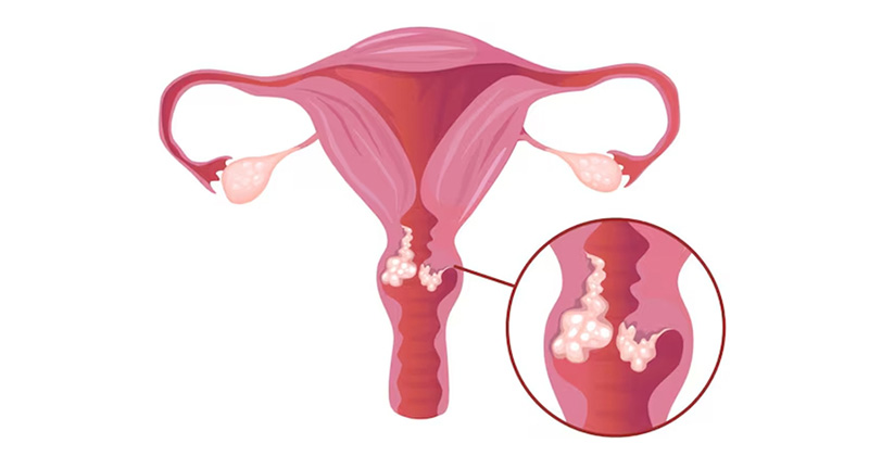 cervical cancer image