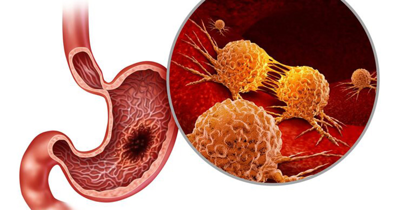stomach cancer image