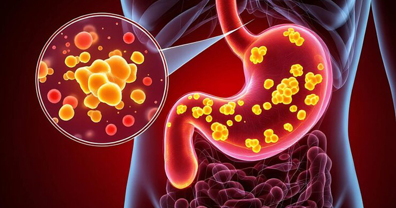 stomach cancer image