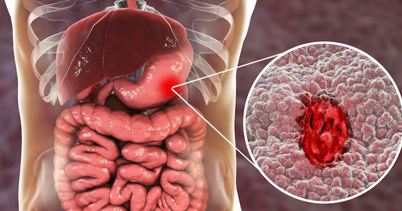 stomach cancer image
