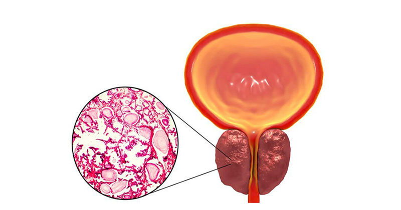 prostate cancer image