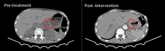 CT scans