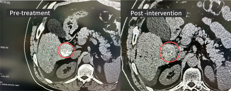 CT scans