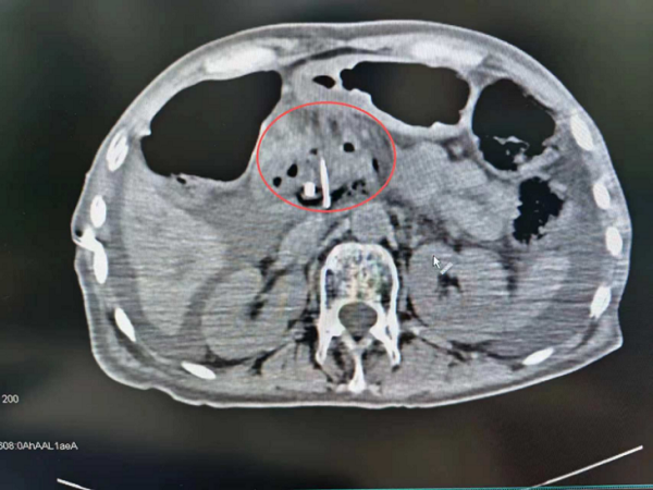 CT scans